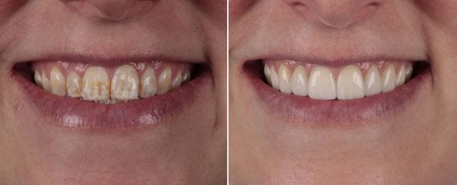 cosmetic dental service before and after teeth with our Lawrenceburg dentist