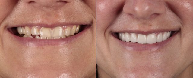 cosmetic dentistry before and after with our Lawrenceburg dentist