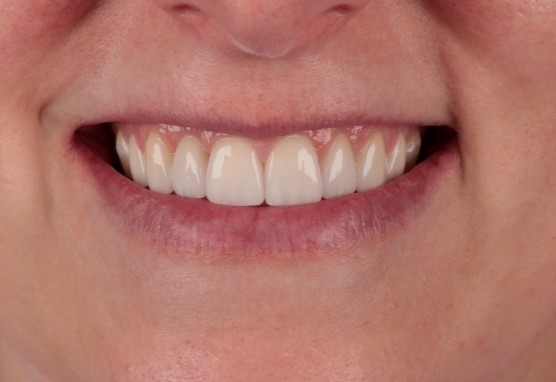After dental treatment with our Lawrenceburg dentist