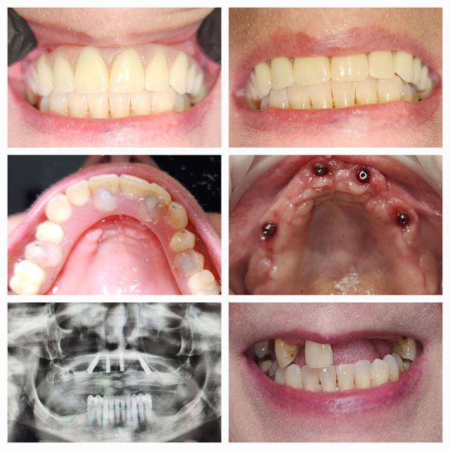After All-on-X treatment with our Lawrenceburg dentist