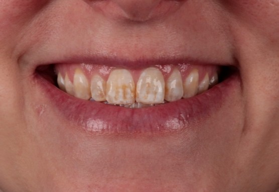 before dental treatment with our Lawrenceburg dentist
