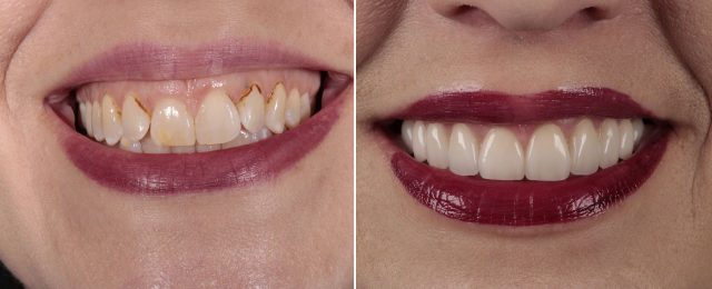 before and after cosmetic dentistry with our Lawrenceburg dentist