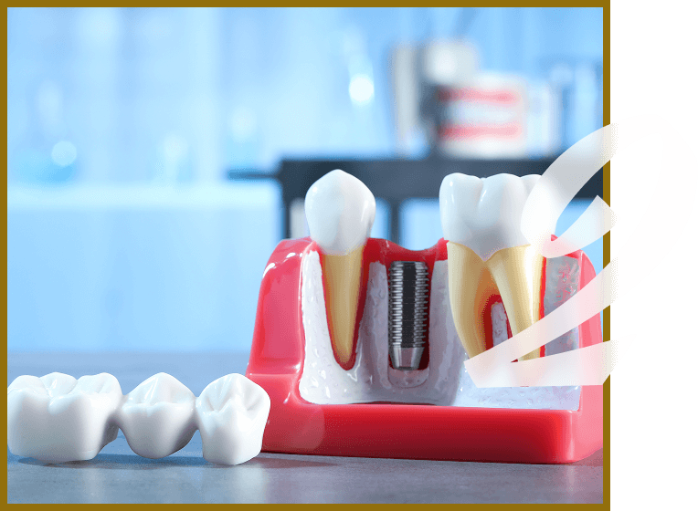 close up of tooth implant model