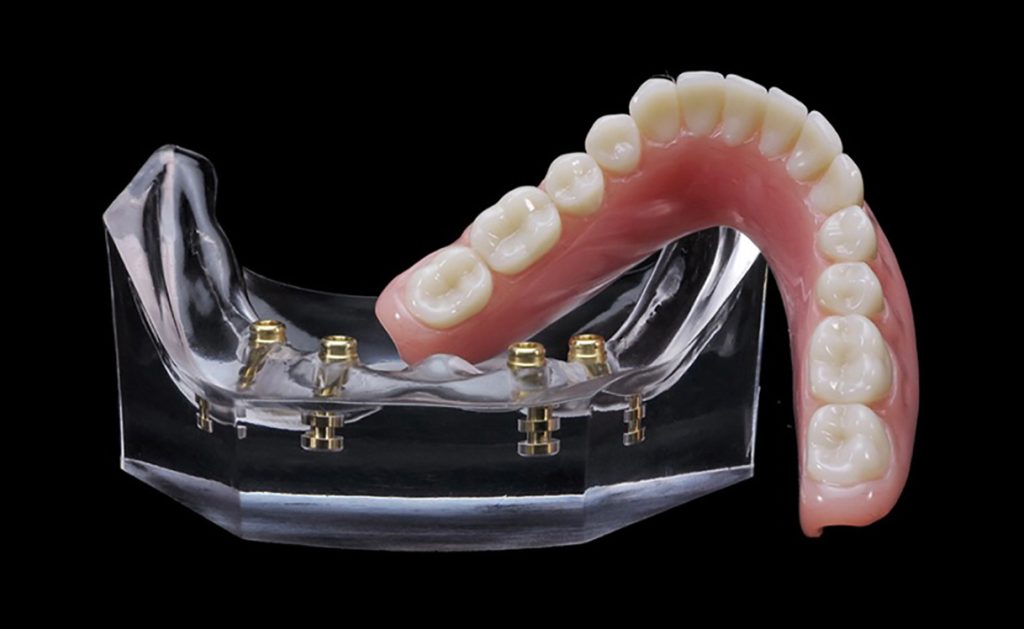 overdenture model