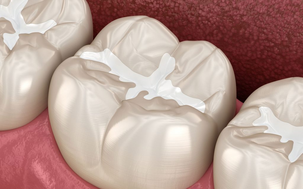 close-up 3d model of dental filling