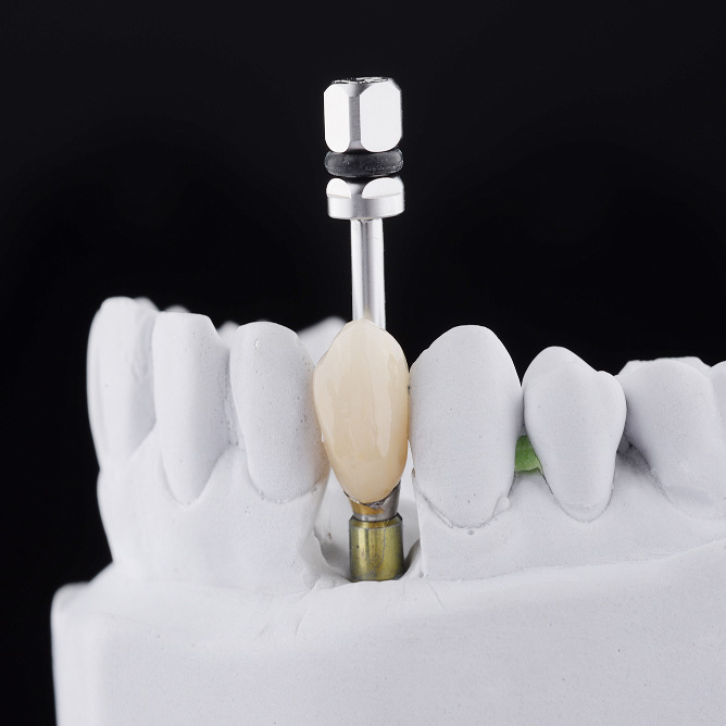 dental implant model on front teeth