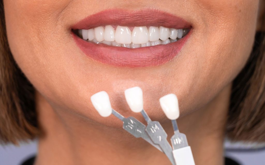 dentist matching patient's tooth color to samples