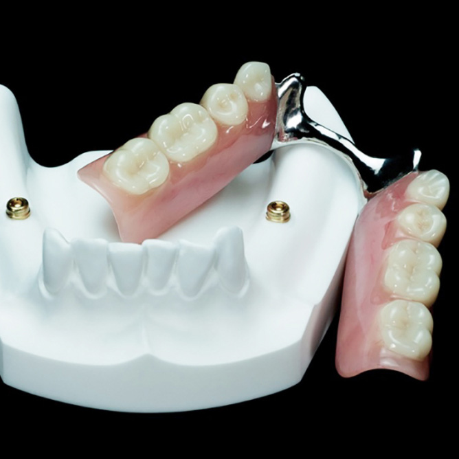 snap-in partial implant denture model