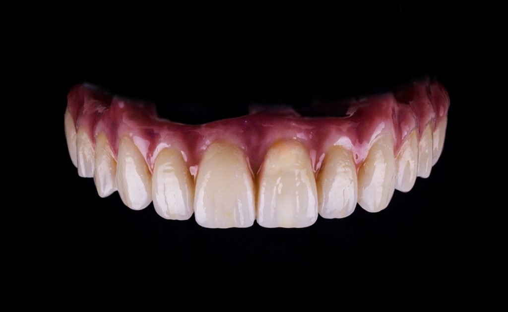 zirconia restoration model